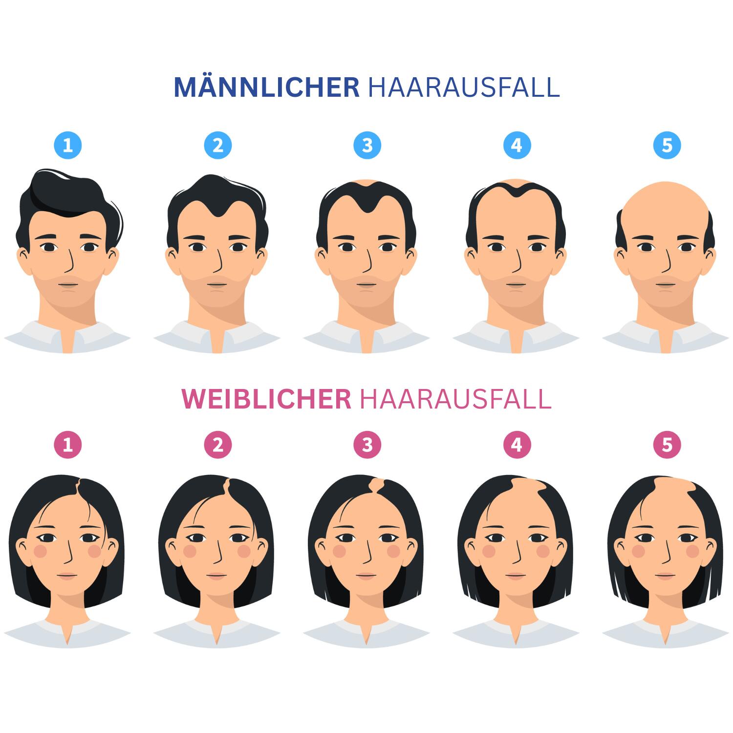 Eine Infografik zeigt die verschiedenen Stadien des androgenetischen Haarausfalls bei Männern und Frauen, von ersten Haarlichtungen bis zu starkem Haarverlust.